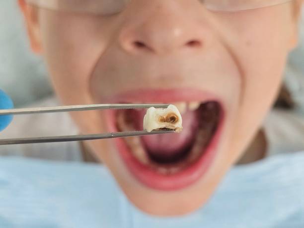 Urgent Tooth Repair in MT